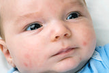 Why Babies Get Acne and What to Do About It?