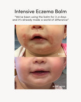 Complete Eczema Care Set view 1