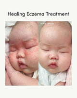 Complete Eczema Care Set view 8