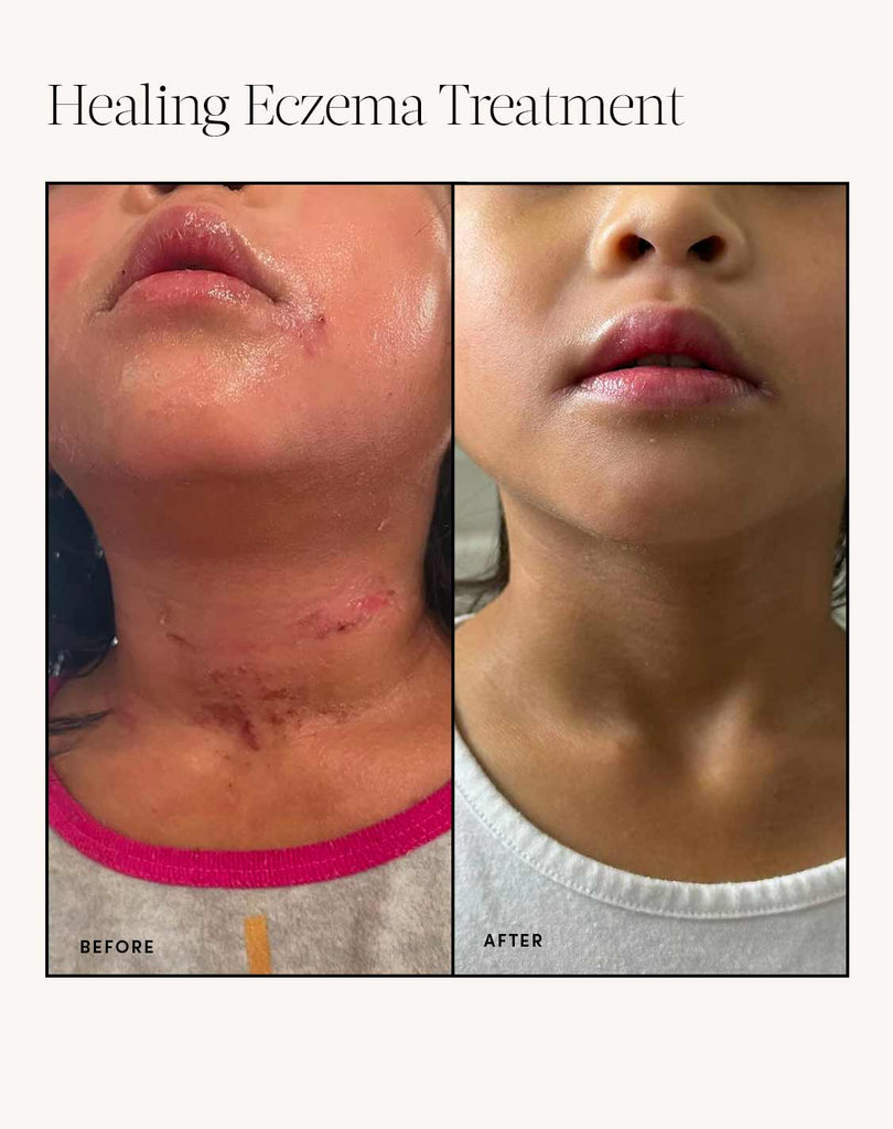 Dry Skin & Eczema Essentials Kit Evereden