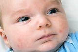 Baby Acne. How to Get Rid of Baby Acne