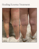 Healing Eczema Treatment